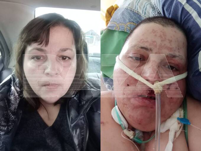 В Улан-Удэ женщина не может питаться после того, как муж облил её кислотой uriqzeiqqiuhkmp qrxiquiuqiqqekrt