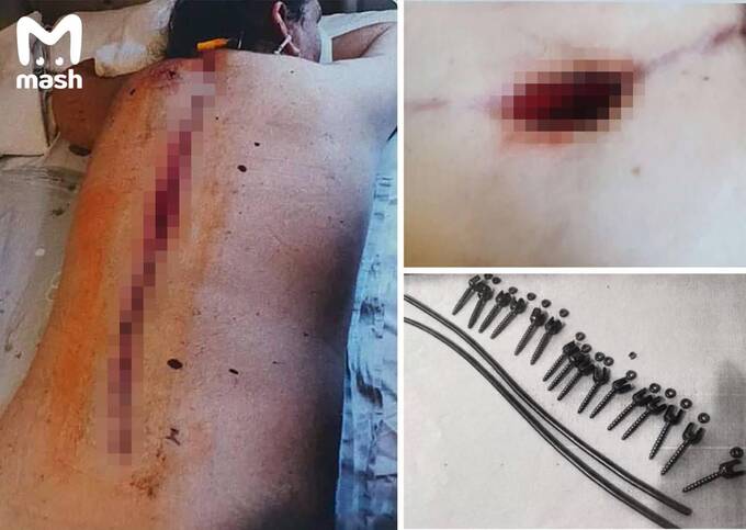 Грубая ошибка в московской клинике привела к параличу пациентки uriqzeiqqiuhkmp qhtixhiqttidzukrt