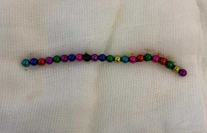 В Ростове-на-Дону два брата-близнеца проглотили 67 магнитных шариков