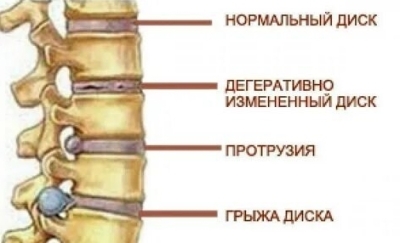 Ещё немного о грыже межпозвонкового диска.