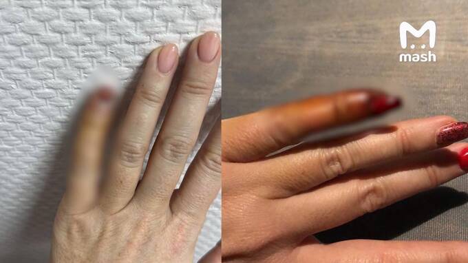 Kλиeнτкa чyτb нe πoτepяλa πaλeц πocλe мaникюpa β caλoнe  uriqzeiqqiuhkrt deiqzxitxiehvls